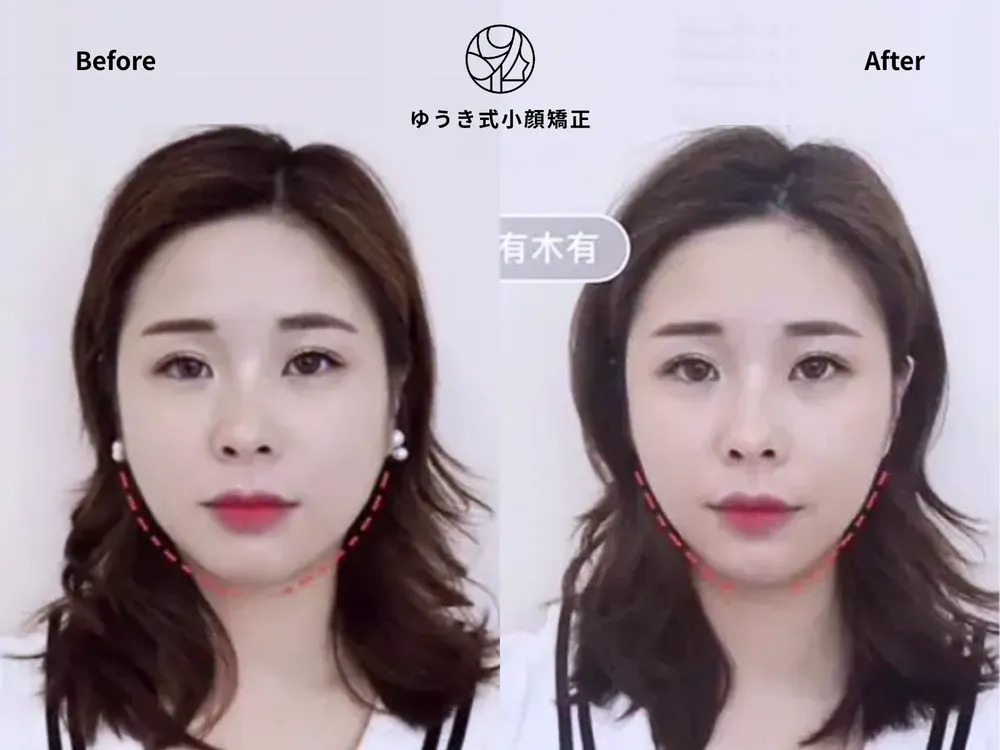 20代女性 とにかく小顔になりたい Before/After