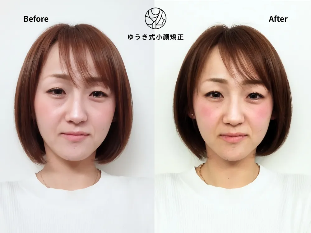 20代女性 出産を機に顔が変わってきた Before/After