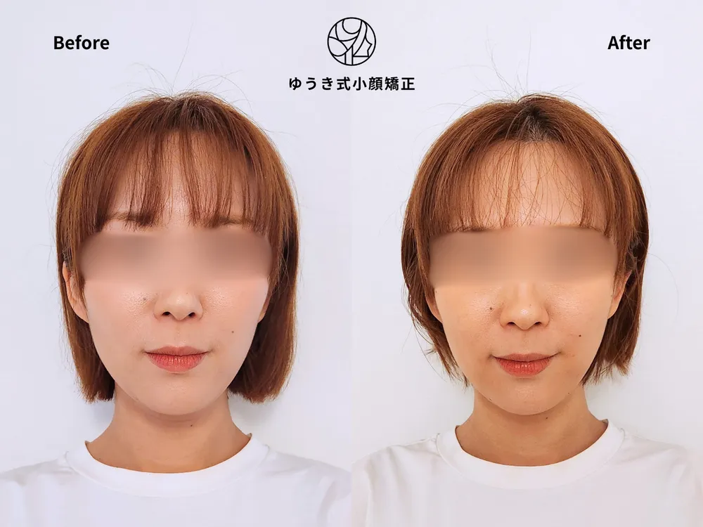 30代女性 顔の歪み、むくまない顔にしたい Before/After