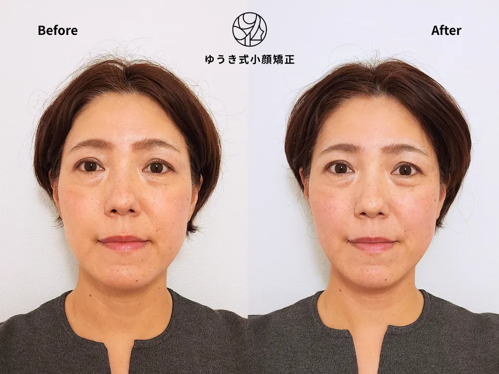 50代女性 たるみと顔が伸びた気がする Before/After